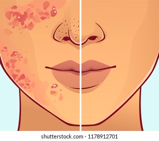 Face with skin problems. Before, after.  Vector illustration