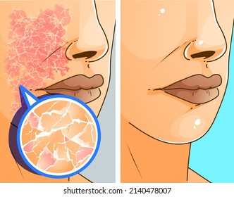 Das Gesicht mit Hautproblemen. Allergie und trockene Haut. Vorher, danach. Illustration im Gesundheitswesen. Vektorgrafik.