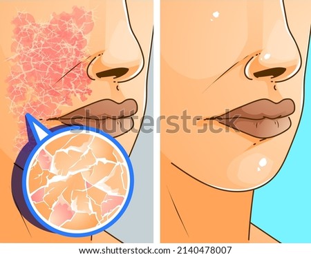 The face with skins problems. Allergy and dry skin. Before, after. Healthcare illustration. Vector illustration.