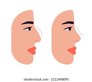 Face woman and correction of profile of nose, changing nasal shape during rhinoplasty surgery. Hump nose and straight nose. Vector illustration