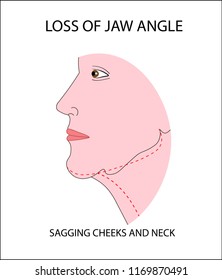 Face of a woman demonstrating aging changes in jaw angle