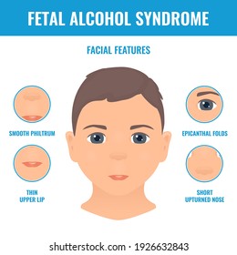 Facial features in a child with fetal alcohol syndrome. Foetal alcohol spectrum disorder signs. FASDs symptoms diagram. Medical concept. Vector illustration.