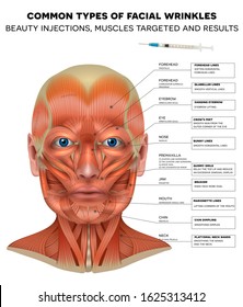 Facial injections info poster, male model face muscles anatomy. Common types of facial wrinkles. Beauty injections treatment areas, treated muscles and results.