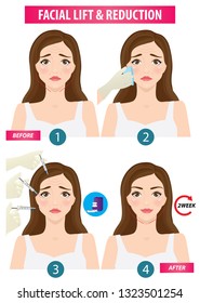 Facial lift and reduction before and after vector illustration
