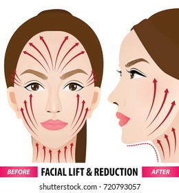 Facial lift and reduction before and after vector illustration
