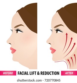 Facial lift and reduction vector illustration