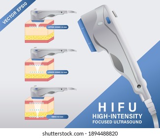 Facial Medical procedure vector of High-Intensity Focused Ultrasound Program (HIFU) for Anti-Aging.