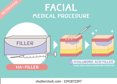 Facial Medical procedure vector of hyaluronic acid filler (HA-Filler)