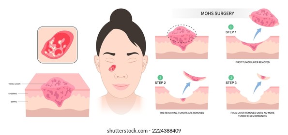 Facial with Mohs surgery basal cell microscopic reconstruction Paget's disease inflammation biopsy