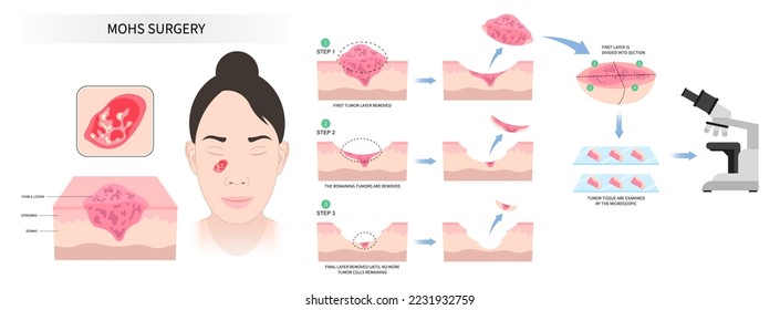 Facial with Mohs surgery basal cell microscopic reconstruction Paget's disease inflammation biopsy