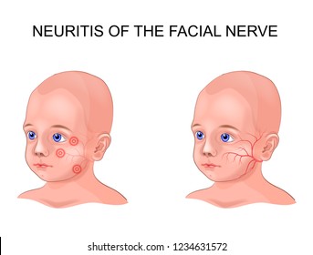 Facial Nerve Neuritis In A Child