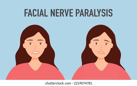 Facial Nerve Paralysis Concept Vector Illustration. Face Palsy.