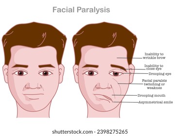 Facial paralysis. Bell palsy. Drooping eyes. twitching weakness causes. asymmetric face, smile. Medical illustration vector