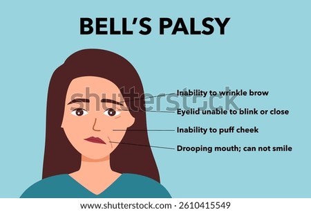 Facial paralysis. Bell palsy. Drooping eyes. twitching weakness causes. asymmetric face, smile. Medical illustration vector