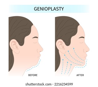 Antes y después de la cirugía de facelift que reduce la grasa alrededor del cuello y las mejillas