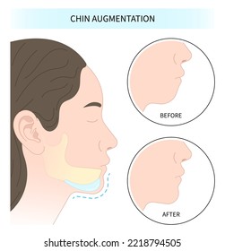 facial reshaping contour and rhytidectomy Orthodontist Temporomandibular joint Orthodontic double long Dermal chin augmentation nose grafting