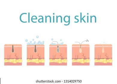 Facial skin care, pore cleaning. Cleansing stages on clogged face. Skin cleaning steps. Vector illustration.