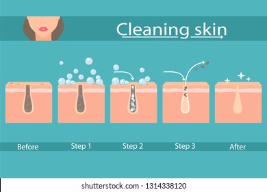 Facial skin care, pore cleaning. Cleansing stages on clogged face. Skin cleaning steps. Vector illustration.