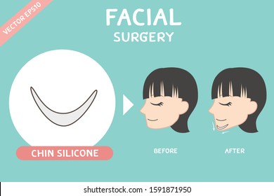 Facial surgery vector of chin surgery