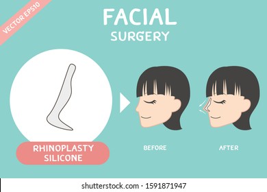 Facial surgery vector of Rhinoplasty surgery