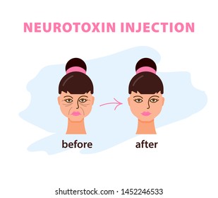 Facial wrinkles treatment before and after. Cosmetic surgery. Woman facial treatment concept. Skin filler.