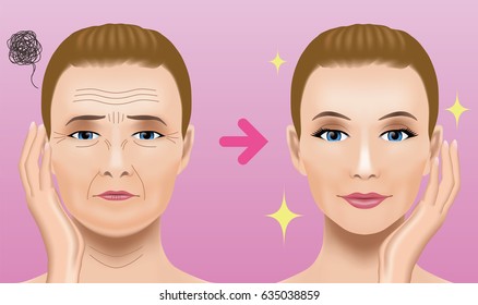 Facial wrinkles treatment before after. cosmetic surgery. woman facial treatment concept.