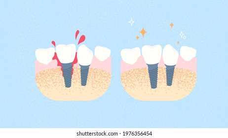 Failed implantation. Tooth implantation. Implant. Dentistry and orthopedics concept.