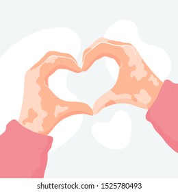 Fair skin hands with vitiligo depigmantation forming a heart shape symbol. Vitiligo awareness, body positivity, self love. Vector. 