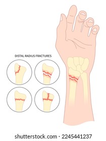 Mano con posición de puño mientras el radio distal fractura la anatomía ósea en medicina