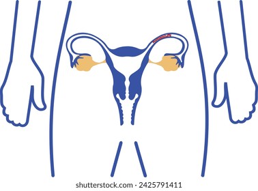 Fallopian Tube Blockade, Female birth defects, ovarian tube