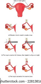 Fallopian tube ligation