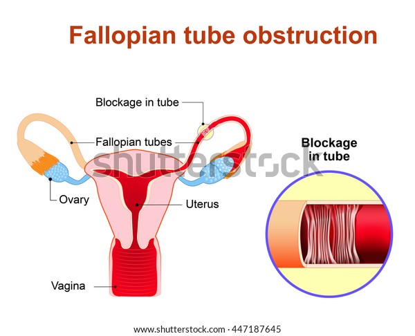 Fallopian\
tube obstruction or Blocked fallopian tubes. A major cause of\
female infertility.  Uterus and uterine tubes. Human anatomy.\
female reproductive system. Vector diagram.\
