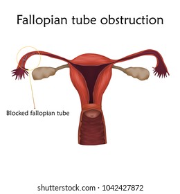 Fallopian tube obstruction. Human realistic uterus. Anatomy illustration with specification. Colored image, white background. Gynecological diseases.