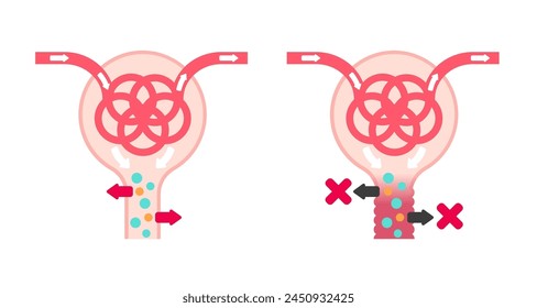 Fanconi-Syndrom verursacht Vektorillustration