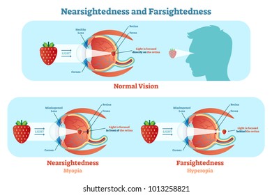 Far Sightedness and Near Sightedness vector illustration diagram, anatomical scheme. Medical educational information. 