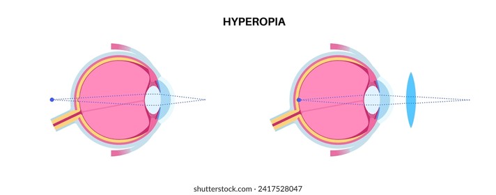 Farsightedness eye disease poster. Hyperopia or long sightedness refractive error concept, problem of blurred vision. Anatomy of human eye, lens and retina, hypermetropia medical vector illustration