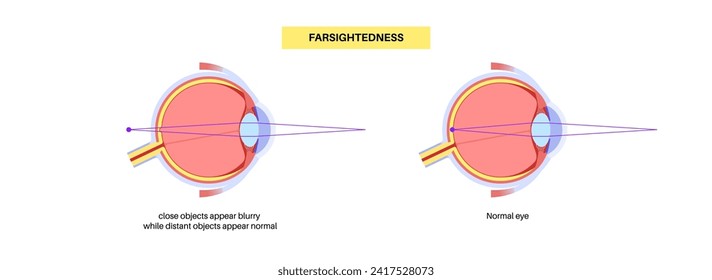 Farsightedness eye disease poster. Hyperopia or long sightedness refractive error concept, problem of blurred vision. Anatomy of human eye, lens and retina, hypermetropia medical vector illustration