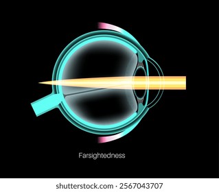 Farsightedness eye disease poster. Hyperopia or long sightedness refractive error concept, problem of blurred vision. Anatomy of human eye, lens and retina, hypermetropia medical vector illustration