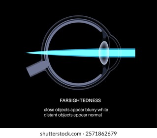 Farsightedness eye disease poster. Hyperopia or long sightedness refractive error concept, problem of blurred vision. Anatomy of human eye, lens and retina, hypermetropia medical vector illustration