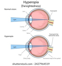 Weitsichtigkeit Hypermetropie Hyperopie Strukturdiagramm Handgezeichnete schematische Vektorgrafik. Medizin-Bildungs-Illustration