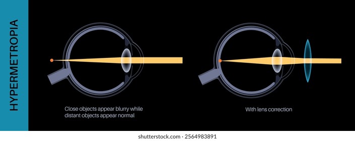 Farsightedness lens correction poster. Hyperopia or long sightedness refractive error concept, problem of blurred vision. Anatomy of human eye and retina, hypermetropia medical vector illustration