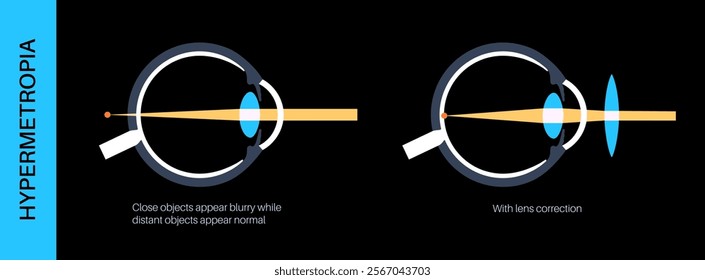 Farsightedness lens correction poster. Hyperopia or long sightedness refractive error concept, problem of blurred vision. Anatomy of human eye and retina, hypermetropia medical vector illustration