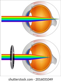 Far-sightedness, long-sightedness, hypermetropia, or hyperopia, is a condition of the eye where distant objects are seen clearly but near objects appear blurred
