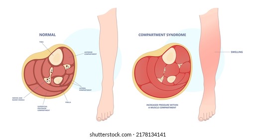 fasciotomy swollen foot acute pain crush limb ischemia deep vein edema fascia broken bone skin graft nerve