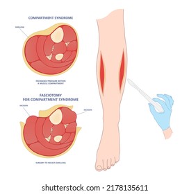 fasciotomy swollen foot acute pain crush limb ischemia deep vein edema fascia broken bone skin graft nerve