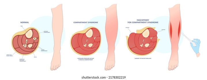 fasciotomy swollen foot acute pain crush limb ischemia deep vein edema fascia broken bone skin graft nerve