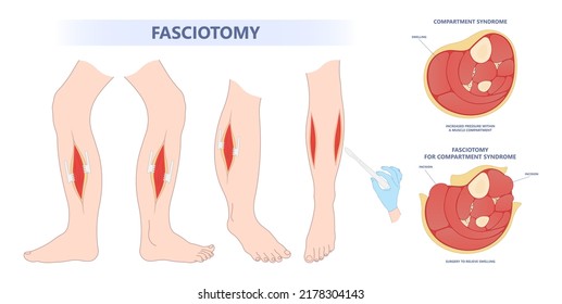 fasciotomy swollen foot acute pain crush limb ischemia deep vein edema fascia broken bone skin graft nerve