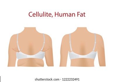 Fat female body with Bra, cellulite, Human Fat, Before and After with Fit body, vector