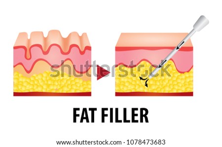 Fat graft before and after vector illustration