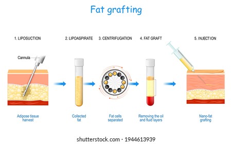 Fat grafting steps: from liposuction (adipose tissue harvest and Collected) to centrifugation for Fat cells separated, and Removing the oil and fluid layers for Nano-fat injection.